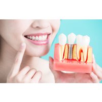 Одноэтапная имплантация зубов: особенности и преимущества