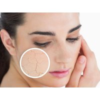 Шелушение кожи на лице: причины и лечение